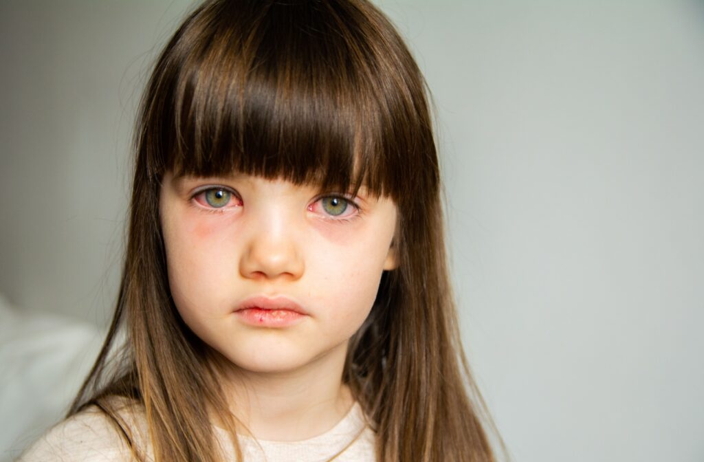 Close-up of a child's face with puffy, red eyes due to conjunctivitis.