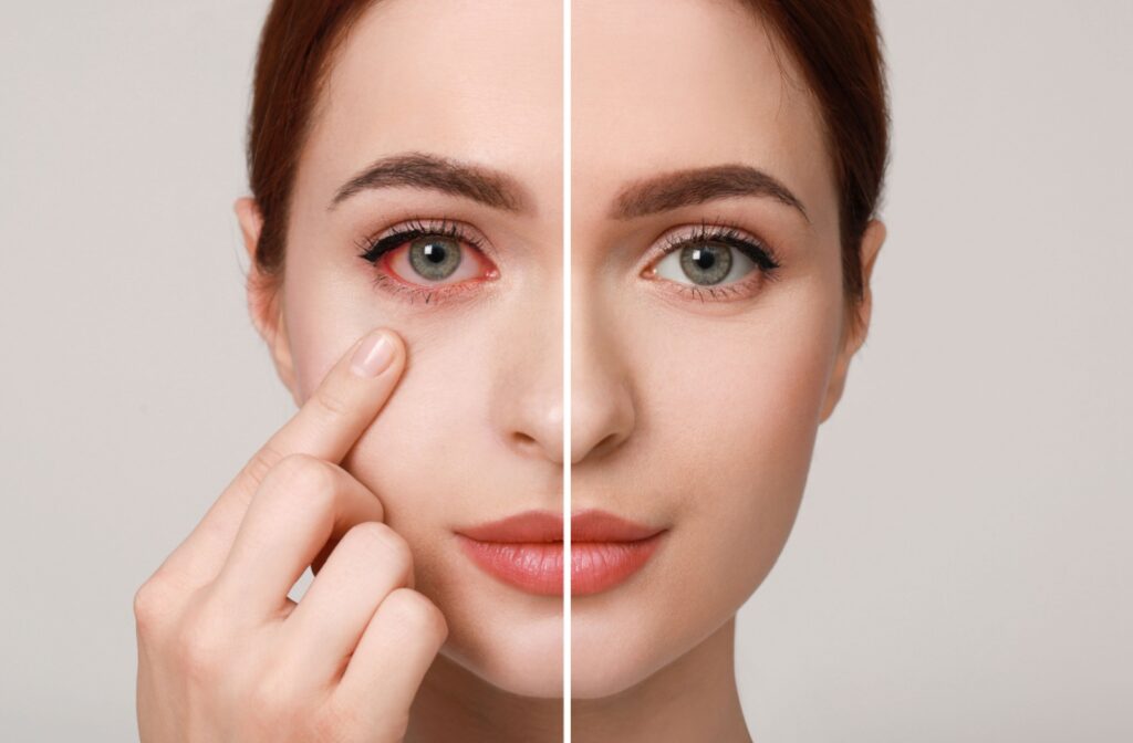 Splitscreen comparison of a person's eyes before and after conjunctivitis symptoms have gone away.