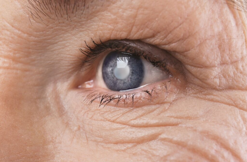 A close-up photo of cataracts in a senior's eye.