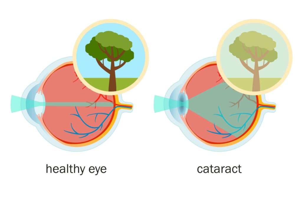 Illustration comparing a healthy eye and an eye with a cataract. The healthy eye on the left shows clear light transmission and a sharp image of a tree. The eye with a cataract on the right shows scattered light and a blurry, faded image of the same tree, indicating impaired vision.